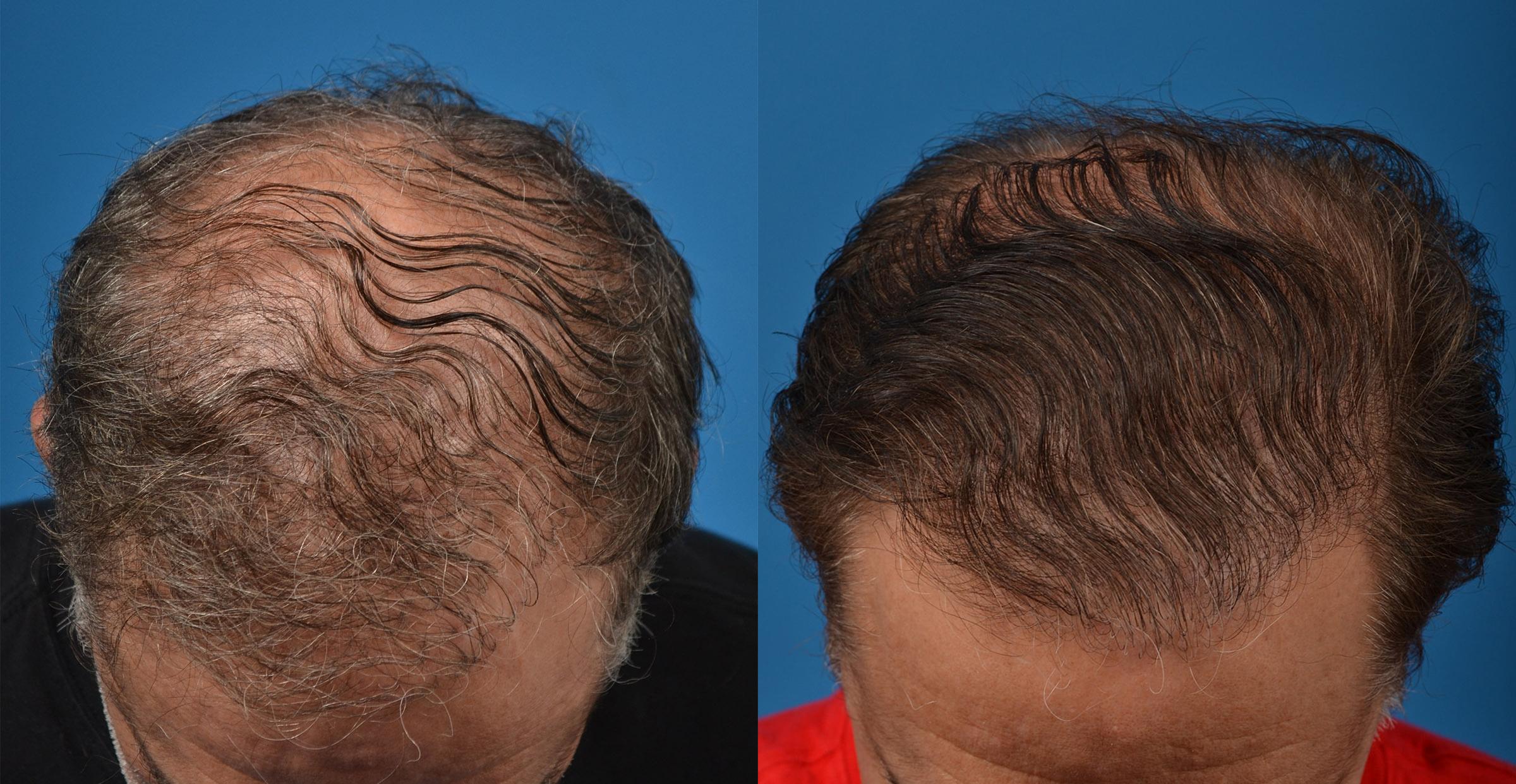 Hair Restoration Photos Melbourne, FL Patient 53714